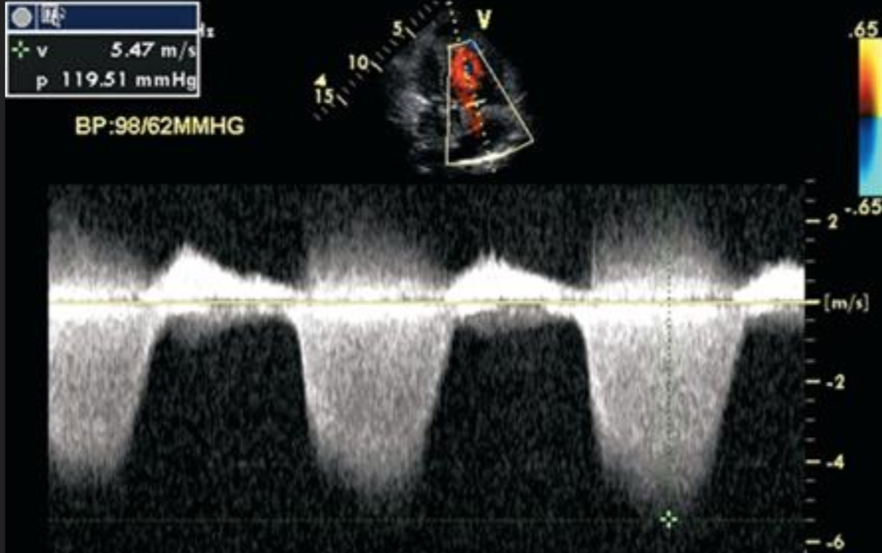 Pulmonary hypertension on your echo What now? echopraxis